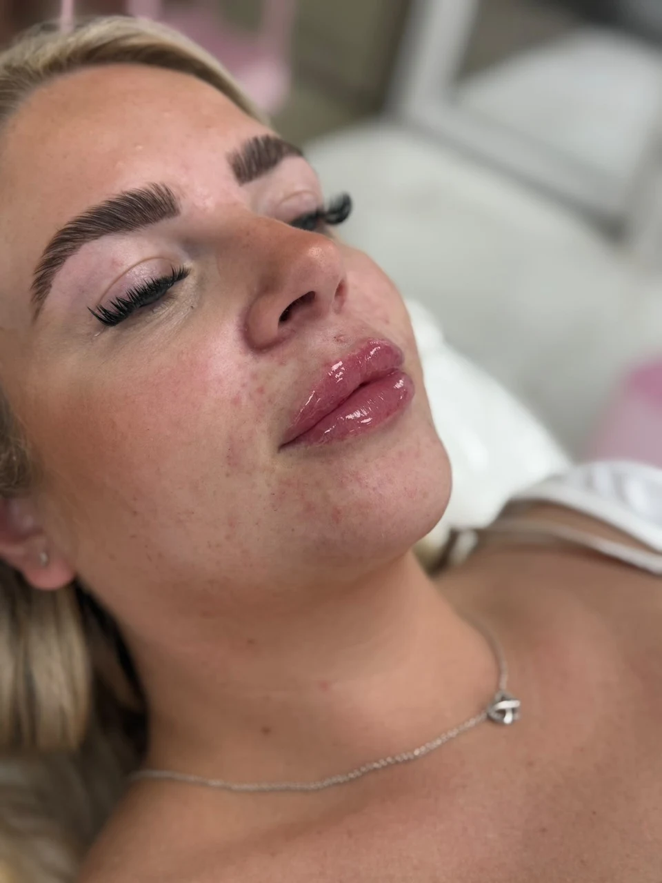 Client lip treatment photograph supplied by SL Aesthetics Beauty