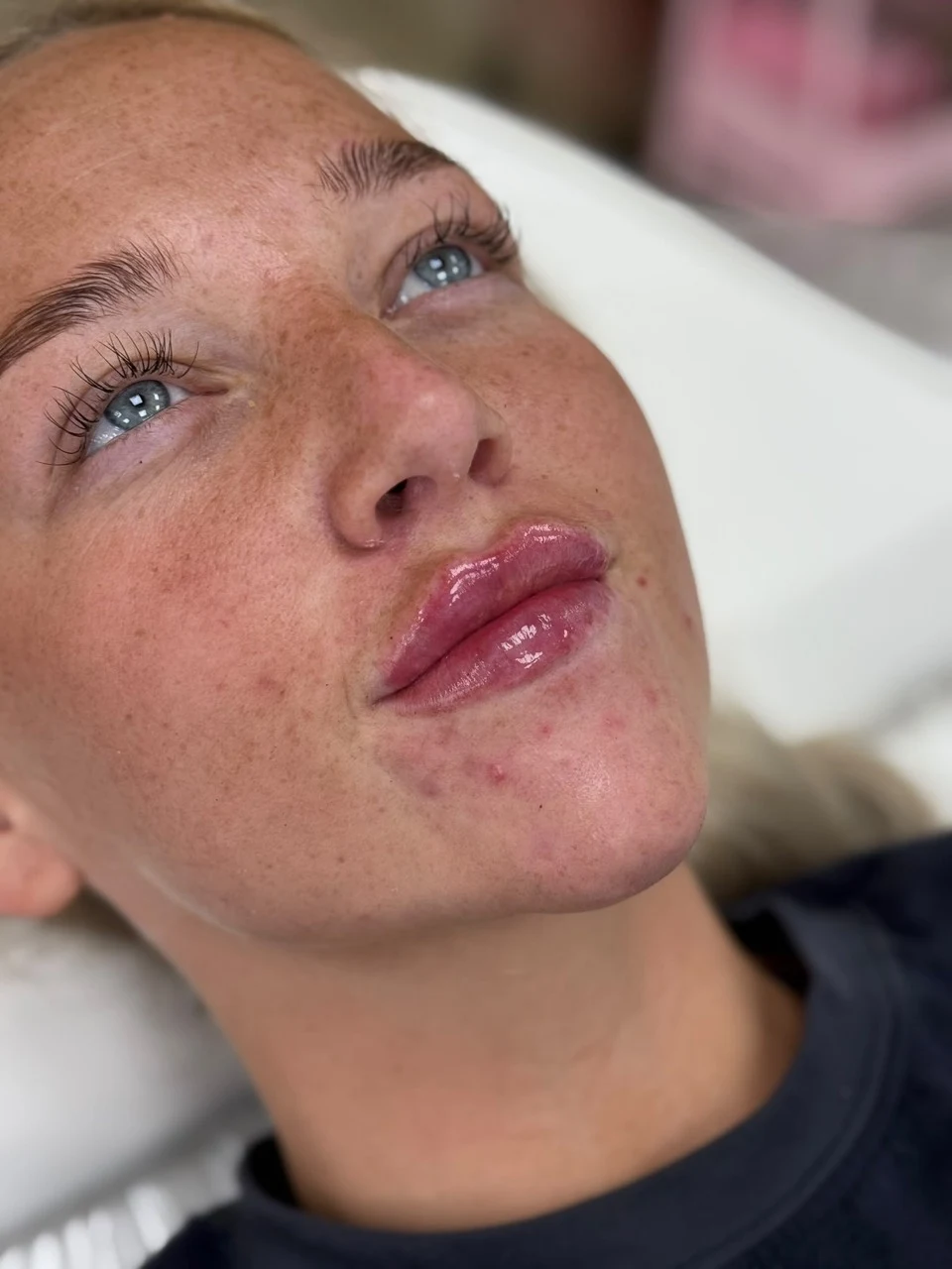A second client lip treatment photograph supplied by SL Aesthetics Beauty